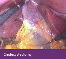 Cholecystectomy