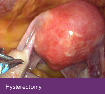 Hysterectomy