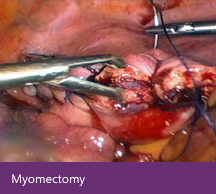 Myomectomy