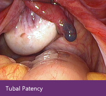 Tubal Patency